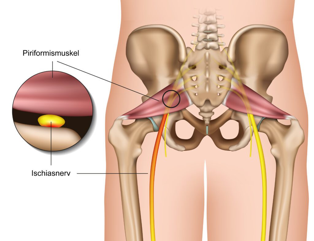 Piriformis Muscle Impacting On Hamstring Range